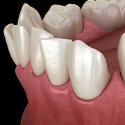 Illustration of gapped teeth