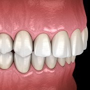 Illustration of an overbite