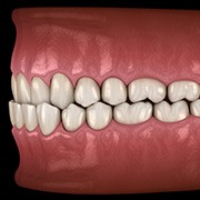 Illustration of an underbite