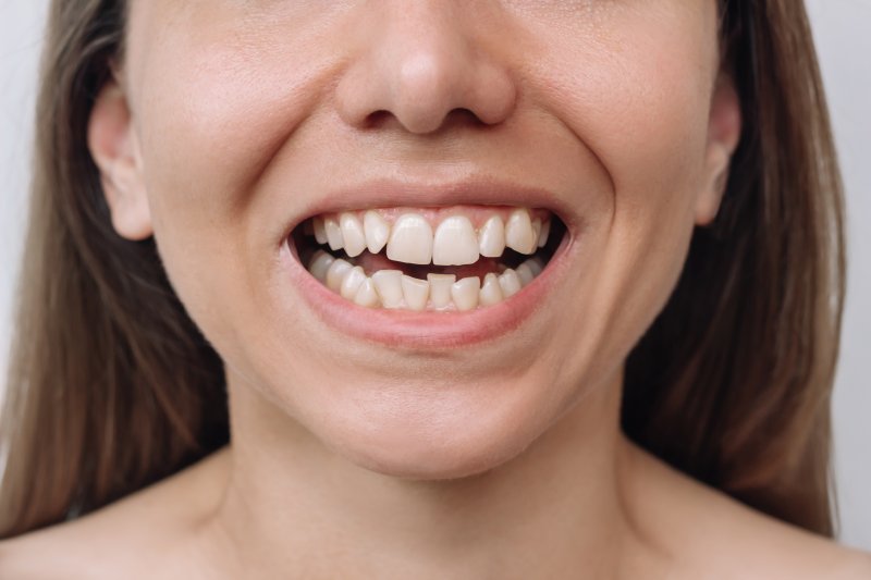 A closeup of a woman with crooked teeth